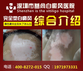 什么药物对白癜风好