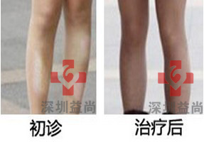 治愈白癜风,找回从前的自己 1.jpg